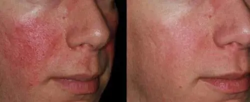 Trattare l'Acne Rosacea: le nuove terapie