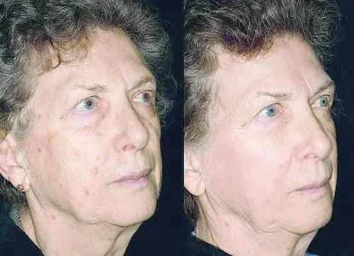 Danni da raggi solari: i rimedi più efficaci e meno invasivi