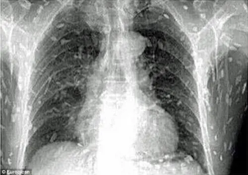 Mangia il sashimi e i vermi gli invadono il corpo