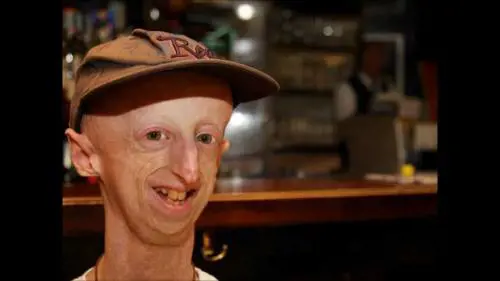 Sammy, non arrendersi a una patologia rara