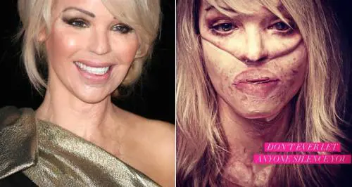 Katie Piper, la modella inglese sfregiata con l'acido dal fidanzato: "Sono orgogliosa delle mie cicatrici"