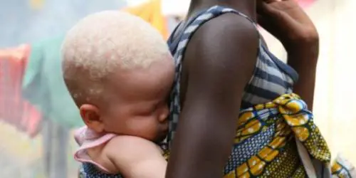 Albino trucidato per stregoneria: "Trovato senza braccia e gambe"