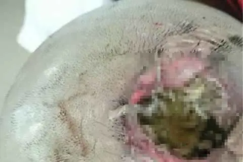 Ha mal di testa, va in ospedale: trovano vermi nel cranio