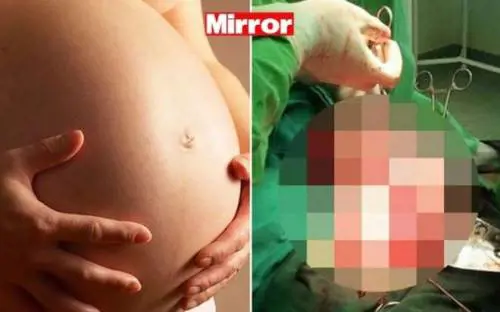 È convinta di essere incinta ma le trovano un cancro di 4 chili