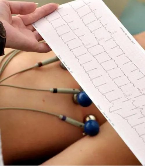 Le aritmie fatali e l'alcol