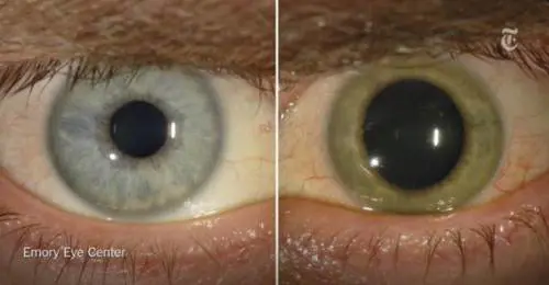 Gli occhi infetti del virus Ebola