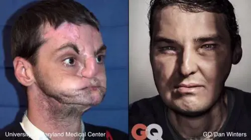 Trapiantata la faccia di un ragazzo morto