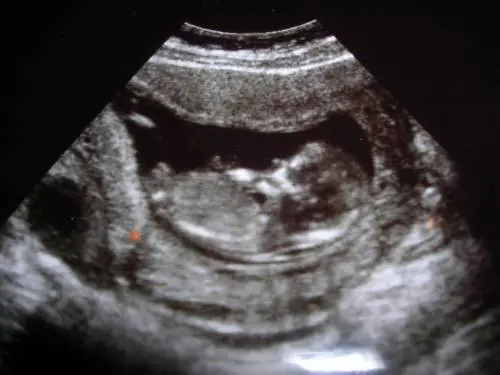 "Ho abortito 18 volte, mio marito voleva un figlio maschio"
