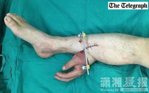 Perde una mano e i medici la attaccano alla gamba