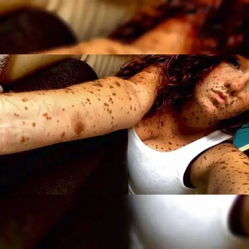 Ha il corpo coperto dai nei: "Così ho reagito al bullismo"