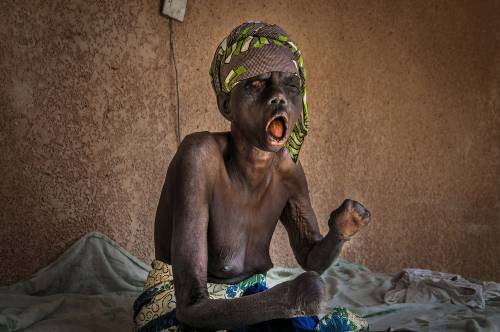 Tra i malati di lebbra dimenticati da tutti nell'Africa profonda