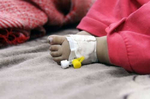 Un bambino malnutrito curato in un ospedale a Sanaa