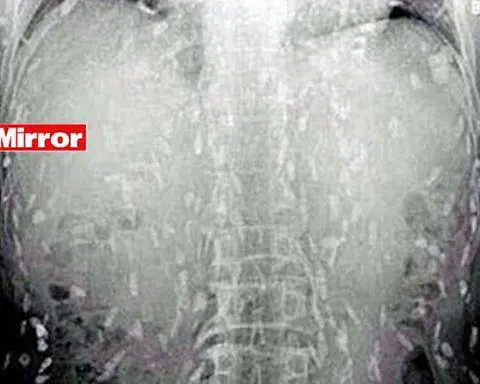 Scienze, caso unico: la tenia cancerogena uccide un uomo