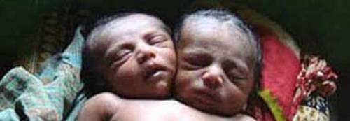 Bangladesh, nata una bambina con due teste