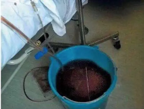 Sangue raccolto nei secchi, sotterranei lugubri e rifiuti radioattivi: la sanità del Lazio