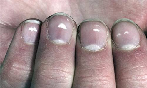 Macchie sulle unghie e tosse frequente: i sintomi dello stress