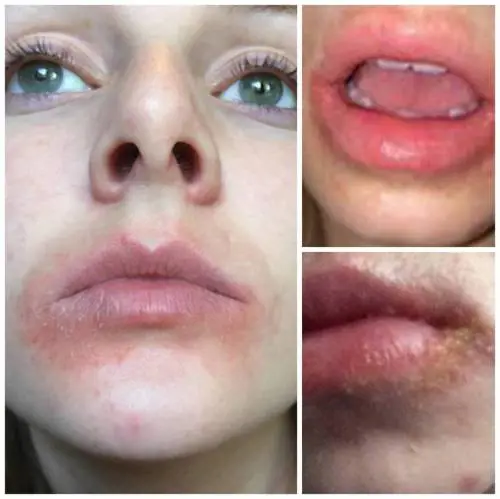 Usa burro di cacao e le compaiono vesciche sulle labbra