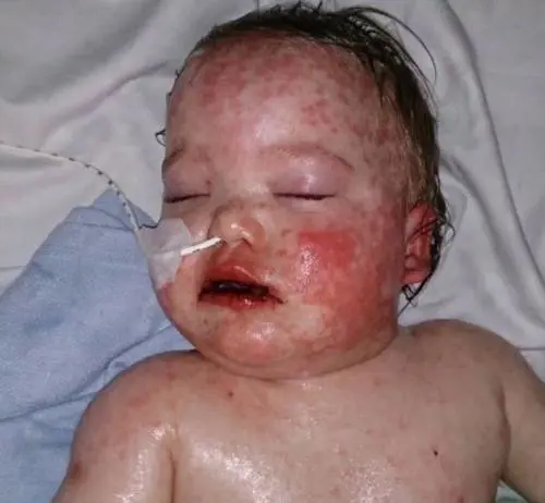 Ibuprofene per il raffreddore. Neonato di 15 mesi rischia la vita