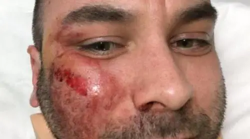Caccia la rom che gli defeca in casa. Pestato a sangue dai nomadi