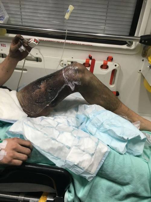 La sigaretta elettronica gli esplode in tasca