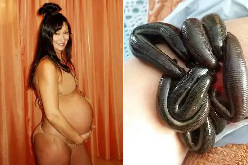 Rimane incinta grazie a 500 sanguisughe