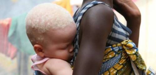 Così vengono sterminati i bimbi albini in Africa