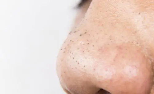 Punti neri sulla pelle: ecco cosa significano