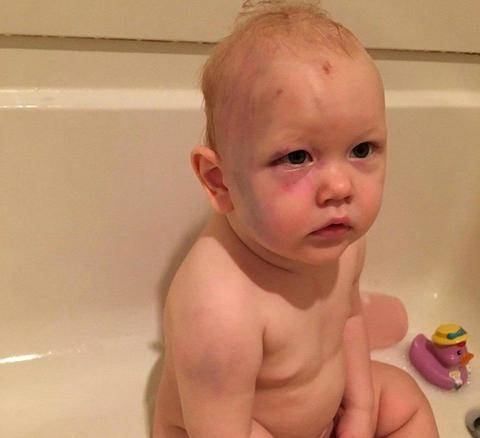 Bambino massacrato dalla baby sitter: la foto choc