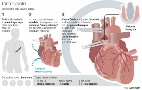Previsto un intervento di quattro ore per la sostituzione della valvola aortica