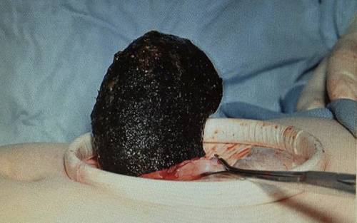 Dottore rimuove sette chili di capelli dallo stomaco di una donna