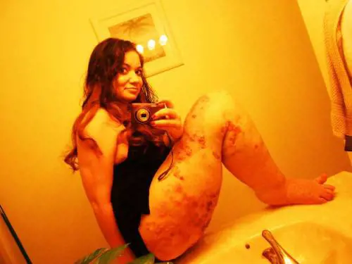 Usa, terribile malattia ha fatto crescere la sua gamba 3 volte il normale: "Non ho mai fatto sesso"