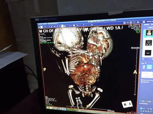 India, i gemelli con un corpo solo