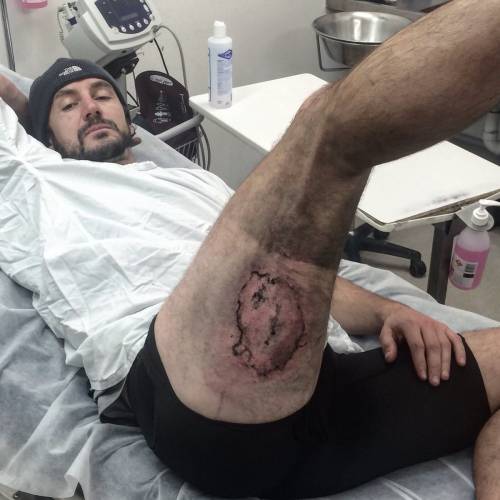 Cade dalla bici e il suo iPhone esplode: ciclista rimane ustionato