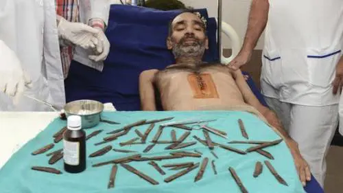 Lo operano per un tumore, ma aveva 40 coltelli in pancia