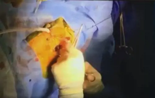 Neonato trapiantato al cuore: genitori pubblicano diretta su facebook