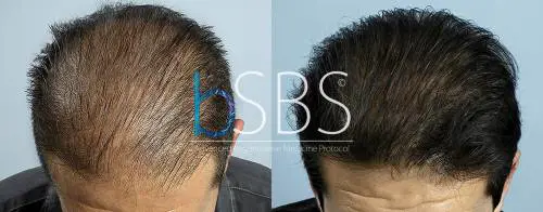 Curare la calvizie? Rigenerazione follicolare al top nella cura della alopecia grazie alle proprie Cellule Staminali