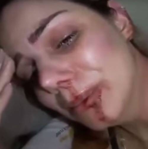 Renata Lustosa massacrata di botte dall'ex: "Cosa faccio con un mostro così?"