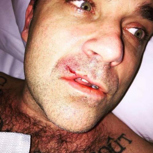 Robbie Williams ferito dopo aver "combattuto" con il suo computer