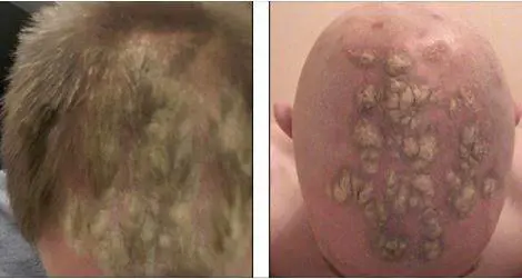 Acquista una cera per i capelli e rimane calvo a soli 24 anni