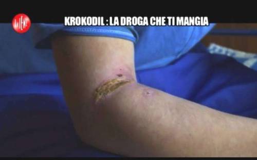 Allerta in Italia per la Krokodil: la droga che scioglie ossa e pelle
