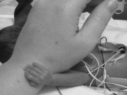 La neonata prematura si aggrappa alla mano dell'infermiera che le cambia il pannolino
