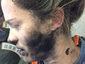 Auricolari esplodono in volo: gravi ustioni per un'australiana