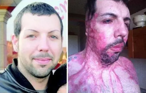 William Pezzullo sfregiato con l'acido: "Giustizia di serie b se la vittima è un uomo"