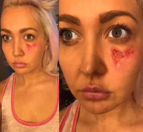 Meghan Linsey morsa da un ragno violino: "Sono contenta di essere viva"