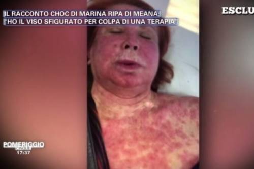 Pomeriggio 5, Marina Ripa di Meana sfigurata: "Ho il volto sfregiato a causa di una terapia"