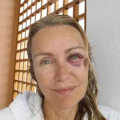 Brutto infortunio per Licia Colò. "Ho rischiato di rompermi la testa"