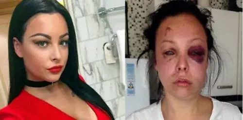 Pestata dal fidanzato: pubblica le foto choc sui social
