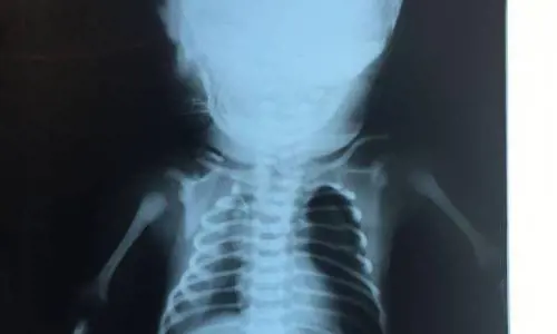 Brasile, colpito da un proiettile nella pancia della mamma: il bimbo resterà paraplegico