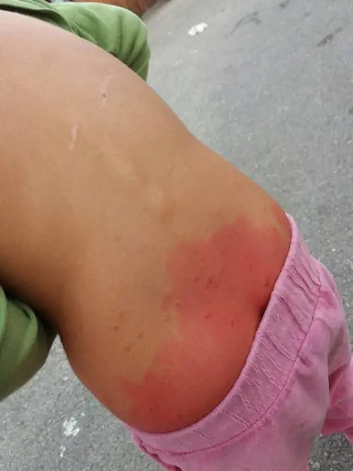 Bimbi rom con la scabbia nel campo nomadi di Castel Romano