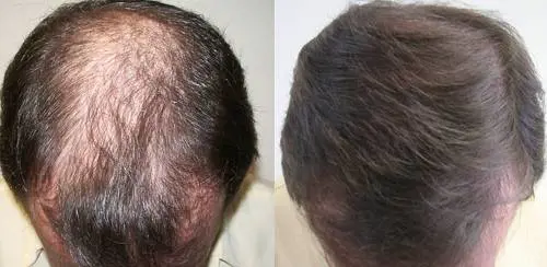 Alopecia, ecco il farmaco che fa recuperare tutti i capelli